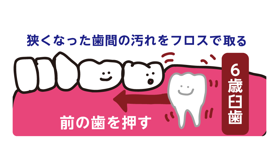 奥歯の成長とともに歯間が狭くなる